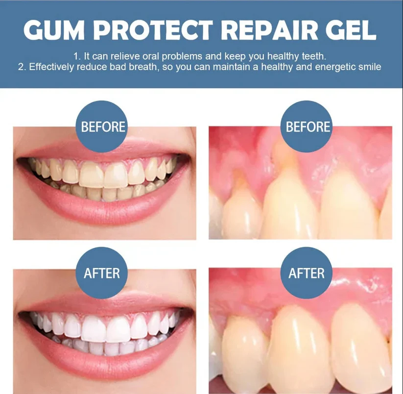 Rolings™ Teeth Repair Gel