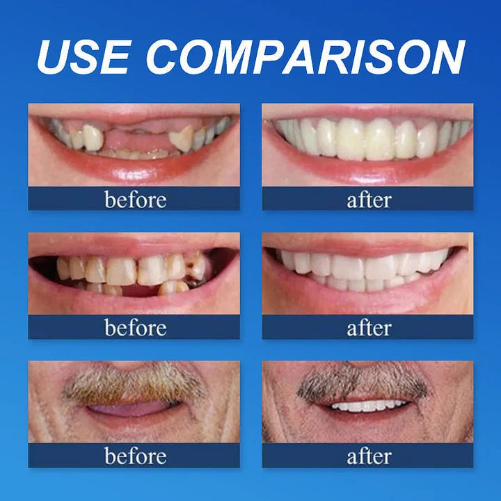 🌎Ends Today: 70% OFF! ⏰specialcoderes™ Medical Full Denture with Strong Suctiond🦷Obtain Dental Association Certification