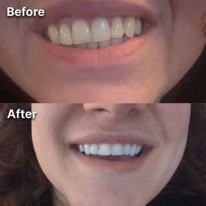 Pearlora™ Whitening Strips — Whiter Teeth After One Use